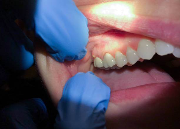 Best Emergency Dental Care for Broken or Chipped Teeth in Pleasureville, KY