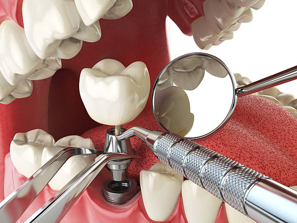 Best Urgent Care for Lost Fillings or Crowns in Pleasureville, KY